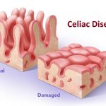 Fast guide to coeliac disease